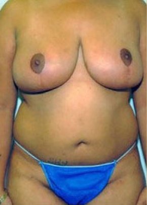 Before and After Breast Reduction in NYC