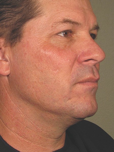 Ultherapy face after