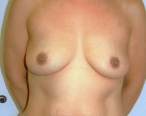 Breast Augmentation Before & After Gallery - Patient 5883065 - Image 1