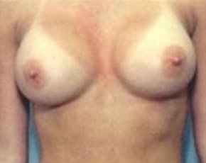 Breast Augmentation Before & After Gallery - Patient 5883194 - Image 2