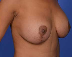 Before and After Breast Lift in NYC
