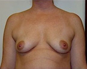 Breast Augmentation Before & After Gallery - Patient 5883248 - Image 1