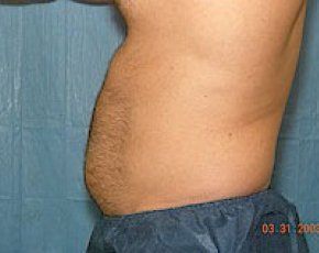 Liposuction and Smartlipo Before & After Gallery - Patient 5883328 - Image 1