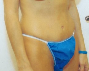 Tummy Tuck Before & After Gallery - Patient 5883337 - Image 2
