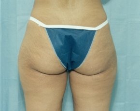 Liposuction and Smartlipo Before & After Gallery - Patient 5883370 - Image 1