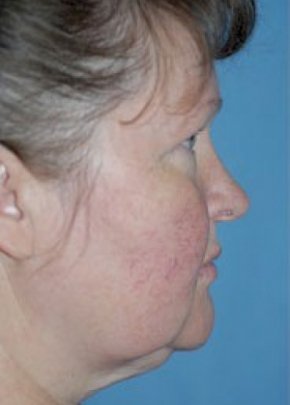 Facelift and Mini Facelift Before & After Gallery - Patient 5883753 - Image 1