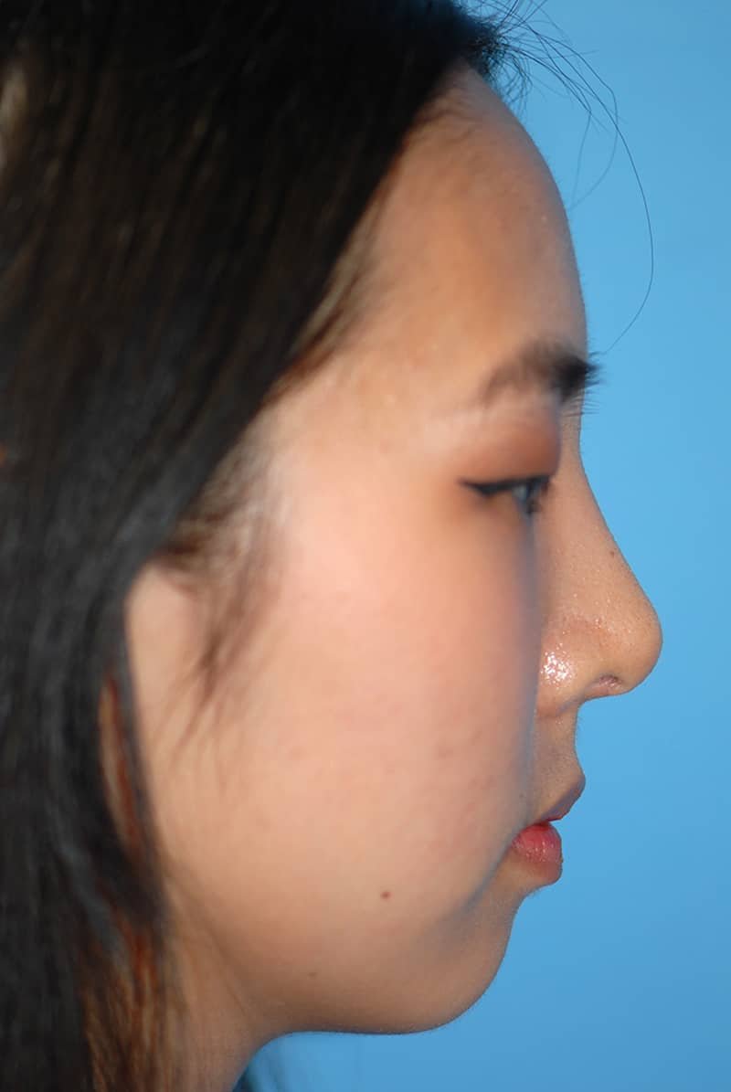 Rhinoplasty Before & After Gallery - Patient 5883817 - Image 6