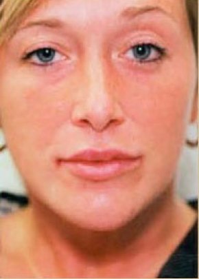Lip Enhancement Before & After Gallery - Patient 5883906 - Image 2