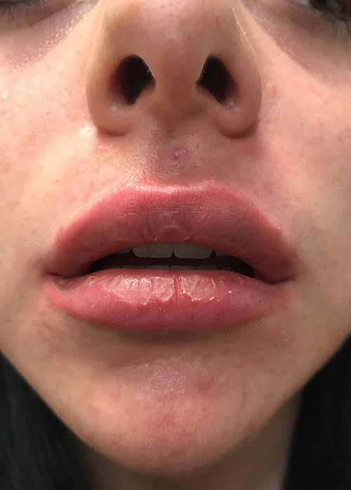 Lip Enhancement Before & After Gallery - Patient 5883912 - Image 2