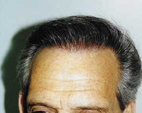 Hair Transplant