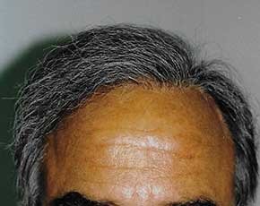 Hair Transplant Before & After Gallery - Patient 5883936 - Image 2