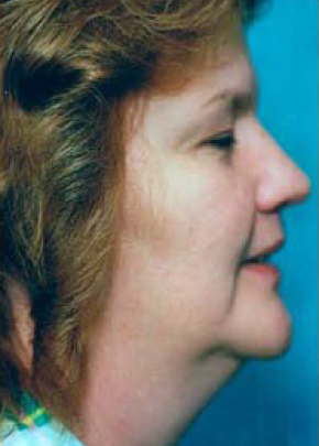 Necklift & Necklipo Before & After Gallery - Patient 5883938 - Image 1