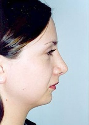 Rhinoplasty Before & After Gallery - Patient 5883940 - Image 2