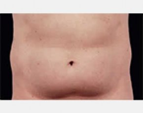 CoolSculpting Before & After Gallery - Patient 5883979 - Image 1