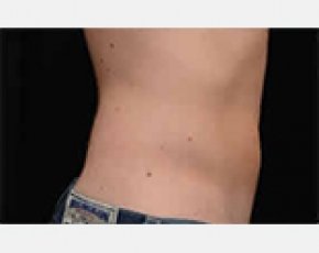 CoolSculpting Before & After Gallery - Patient 5883984 - Image 2