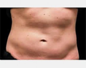CoolSculpting Before & After Gallery - Patient 5883996 - Image 1