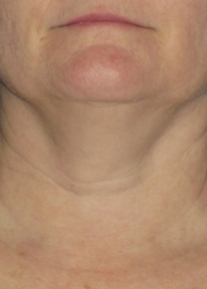 Ultherapy Before & After Gallery - Patient 5884018 - Image 1