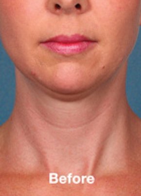 Kybella Before & After Gallery - Patient 5884022 - Image 1