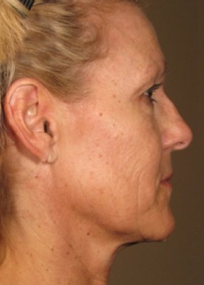 Ultherapy Before & After Gallery - Patient 5884043 - Image 2
