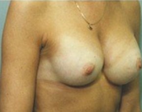 Breast Augmentation Before & After Gallery - Patient 5946254 - Image 2