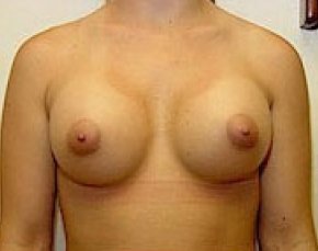 Breast Augmentation Before & After Gallery - Patient 5946309 - Image 2