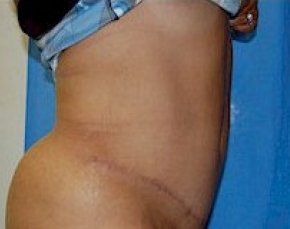 Tummy Tuck Before & After Gallery - Patient 5946347 - Image 4
