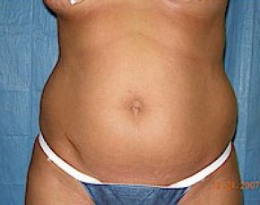 Liposuction and Smartlipo Before & After Gallery - Patient 5946691 - Image 1