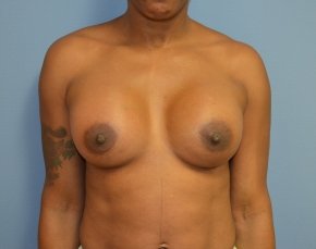 Breast Lift with Implants Before & After Gallery - Patient 5947654 - Image 2