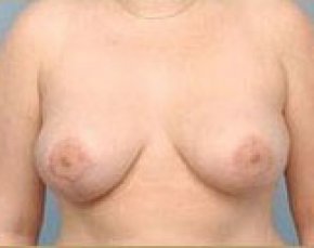 Breast Lift and Reduction Before & After Gallery - Patient 5951171 - Image 2