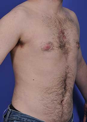 Male Breast Reduction Before & After Gallery - Patient 5951217 - Image 2