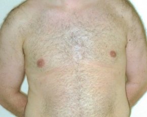 Male Breast Reduction Before & After Gallery - Patient 5951454 - Image 2