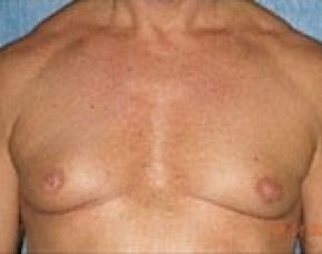 Male Breast Reduction Before & After Gallery - Patient 5951679 - Image 1