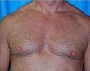 Male Breast Reduction Before & After Gallery - Patient 5951679 - Image 2