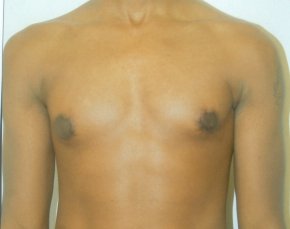 Male Breast Reduction Before & After Gallery - Patient 5951686 - Image 2