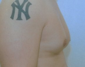 Male Breast Reduction Before & After Gallery - Patient 5951698 - Image 1