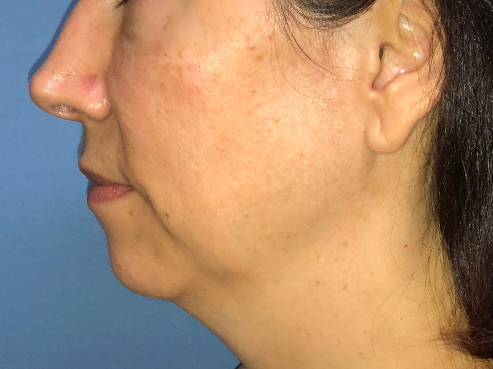 Necklift & Necklipo Before & After Gallery - Patient 154108593 - Image 1