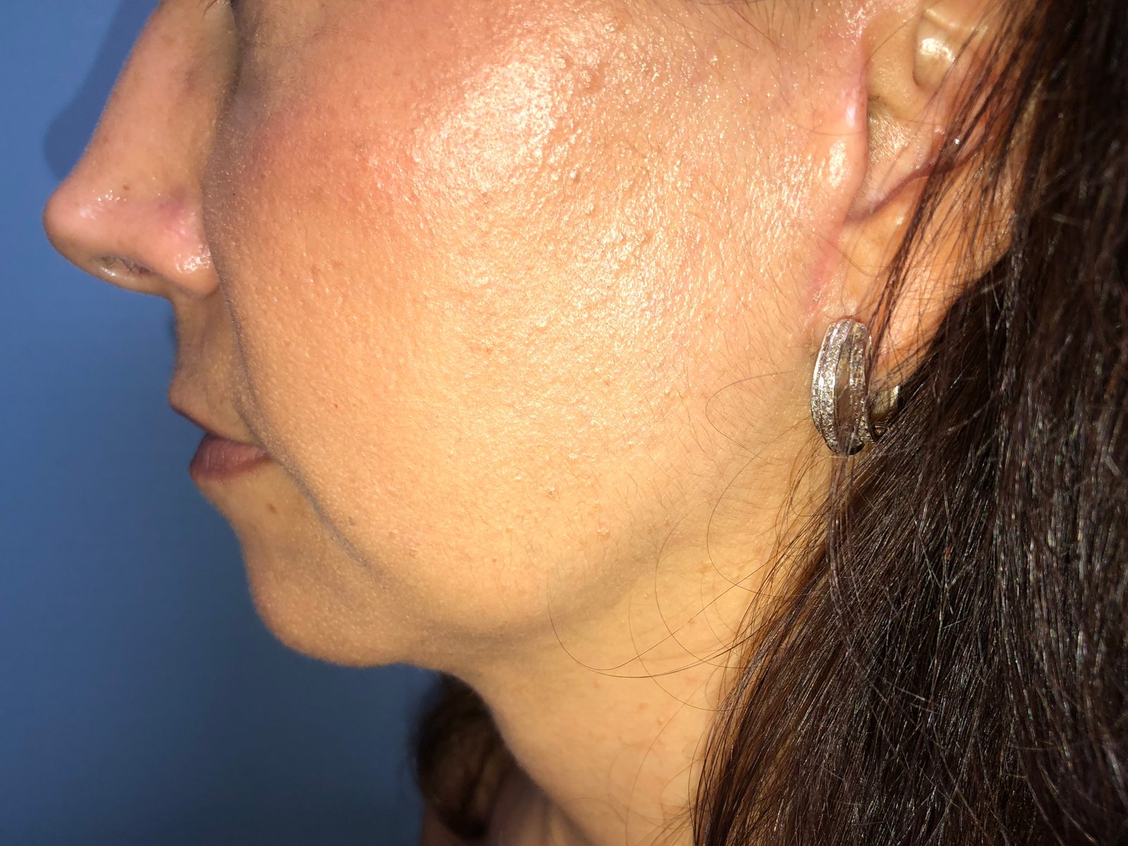 Necklift & Necklipo Before & After Gallery - Patient 154108593 - Image 2