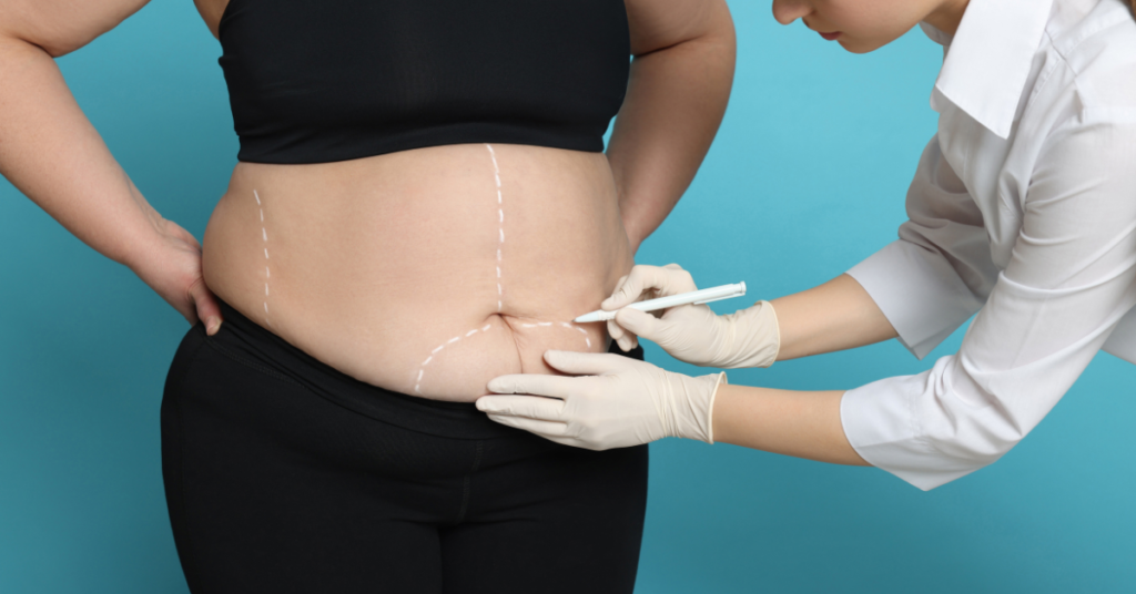 How Many Areas Can I Liposuction at One Time?