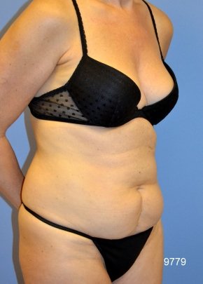 Liposuction