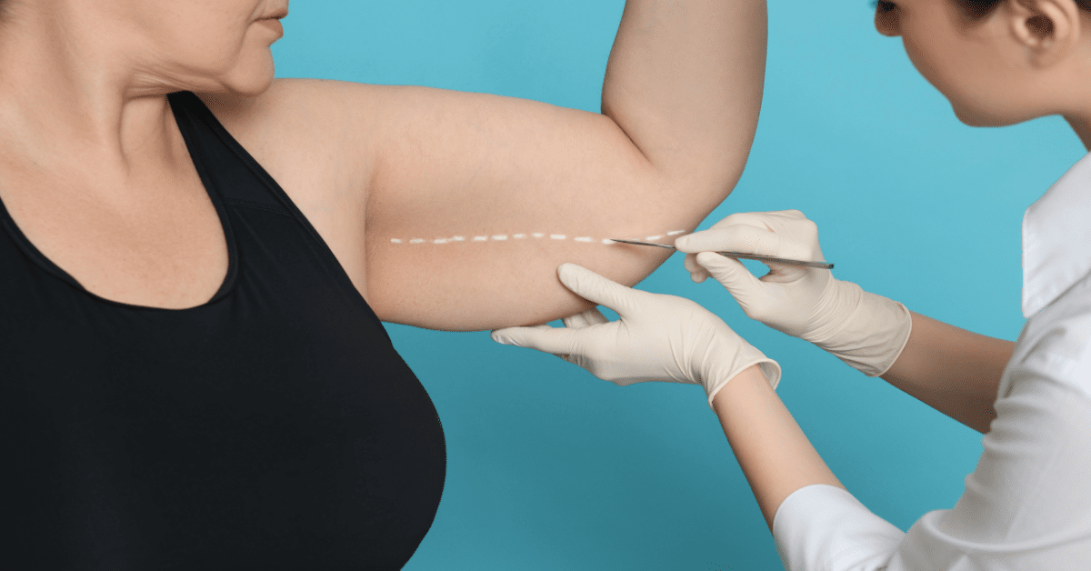 Is Arm Liposuction Worth It?