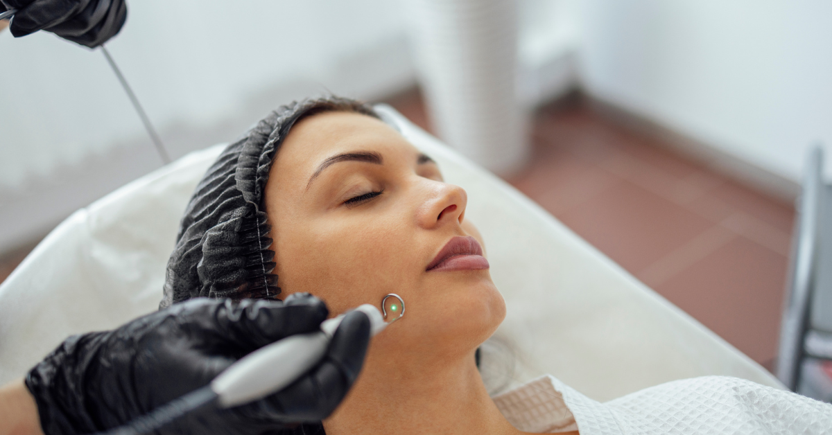 What to Expect from Laser Treatment for Acne Scars?