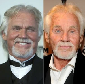 Kenny Rogers Plastic Surgery: What Went Wrong?